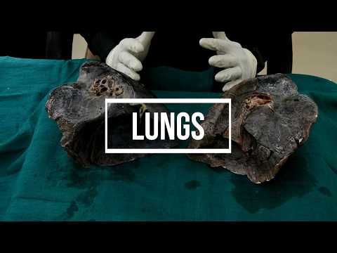 Lungs - gross anatomy