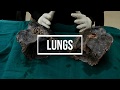 Lungs - gross anatomy