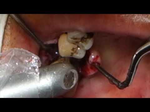 Peri-Implantitis with LIGHTMED's SAPPHIRE Laser
