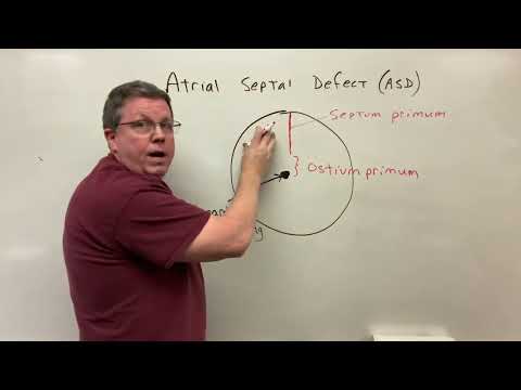 Atrial Septal Defect A Simple Explanation