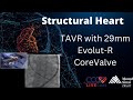 TAVR With 29mm Evolut R CoreValve Structural Heart Sept 2017