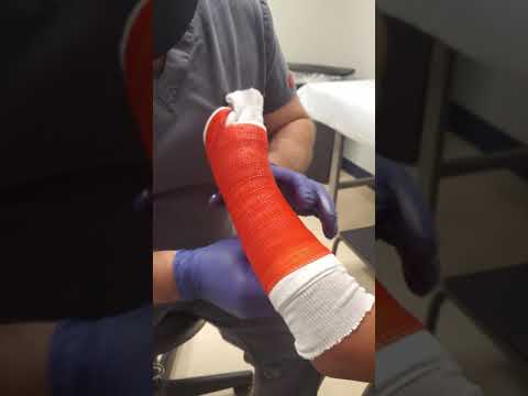 Как наложить стекловолоконный гипс с короткой рукояткой