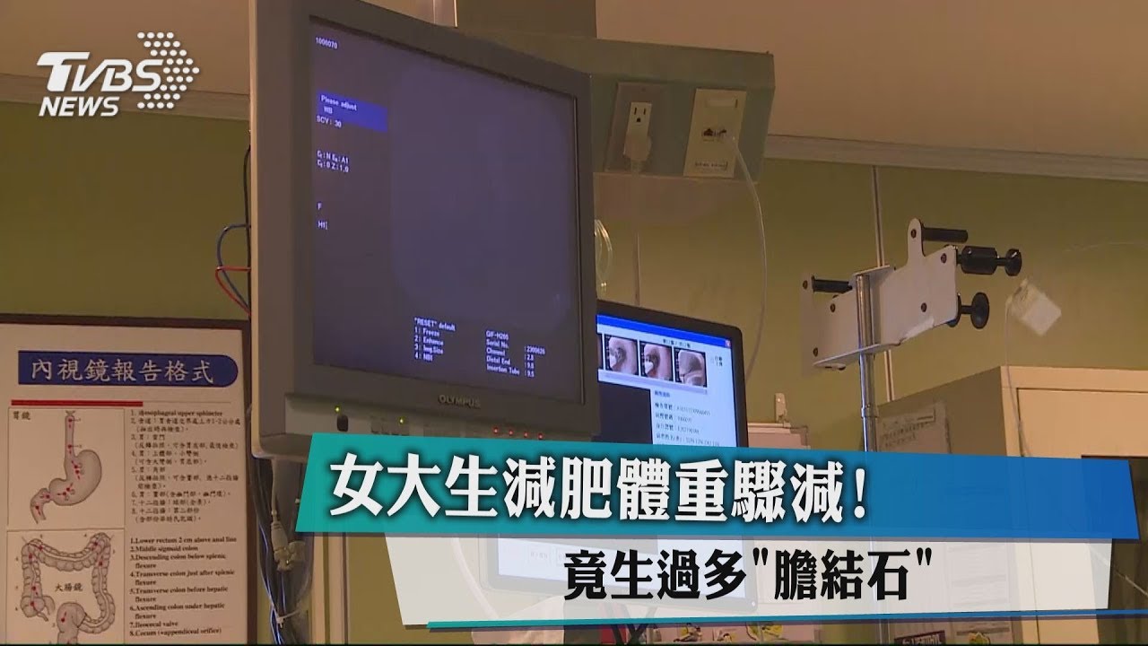 女大生減肥體重驟減！　竟生過多「膽結石」