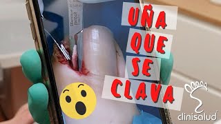 Uña Encarnada: solución definitiva (testimonio)