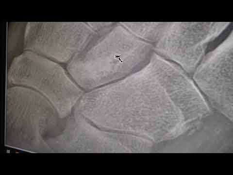 AVN 3rd Cuneiform,  foot bone death and pain before and after surgery