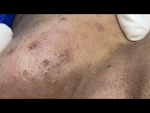 Pimples Popping and Blackhead Extractions