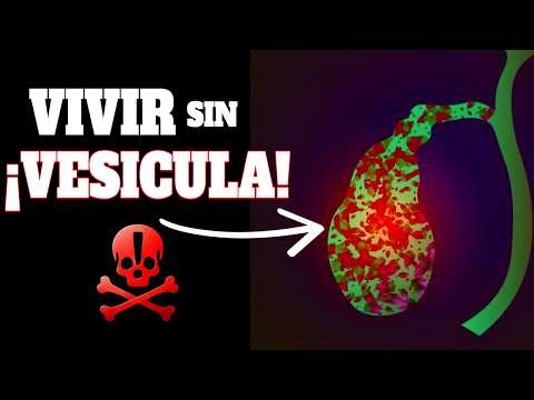 This HAPPENS if your GALLBALL is removed – GALLBALL STONES