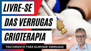 Como  Feita a Crioterapia Para Eliminar Verrugas | Como Eliminar Verrugas | Como Tirar Verrugas |