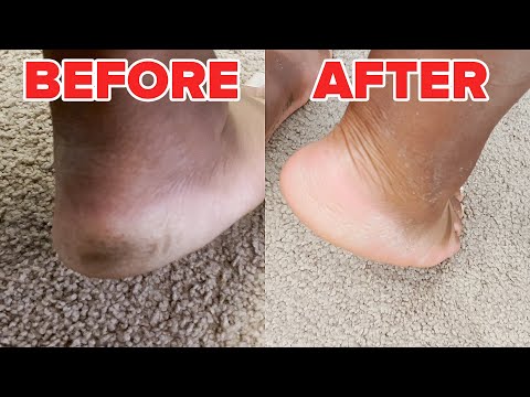 We Used A Foot Peeling Mask For The First Time（We Used A Foot Peeling Mask For The First Time）