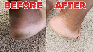 We Used A Foot Peeling Mask For The First Time