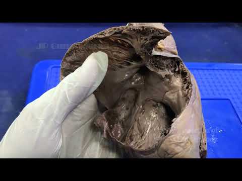 Interior of Right atrium: Clinical and Embryological significance