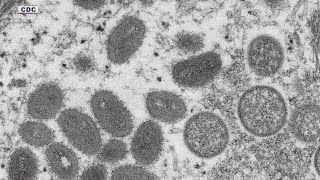 1st case of monkeypox in 2022 detected in the U.S.