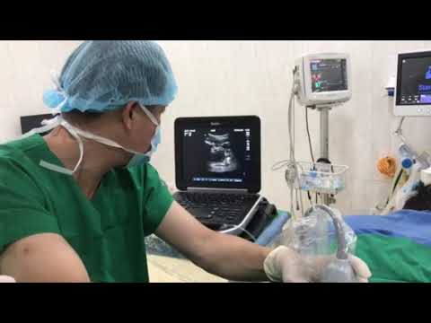 Thoracolumbar Interfascial Plane Block (TLIP Block)