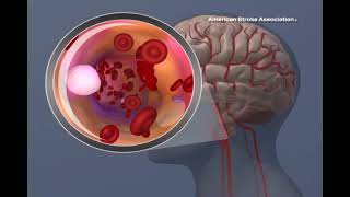 Ischemic Stroke Animation
