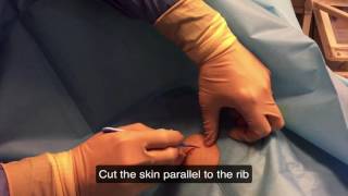 Chest tube insertion for pneumothorax or hematothorax