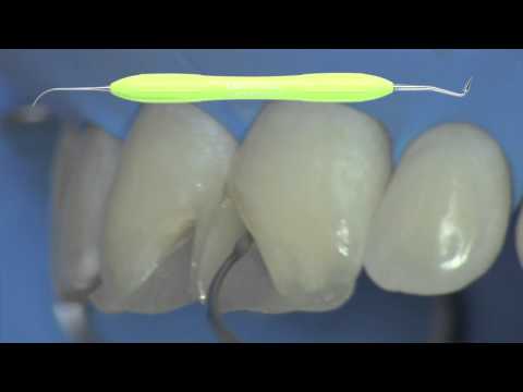 LM-SlimLift™ C3 - LM-Dental
