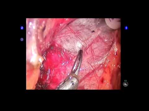 Robotic Excision of Giant Seminal Vesicle Cyst