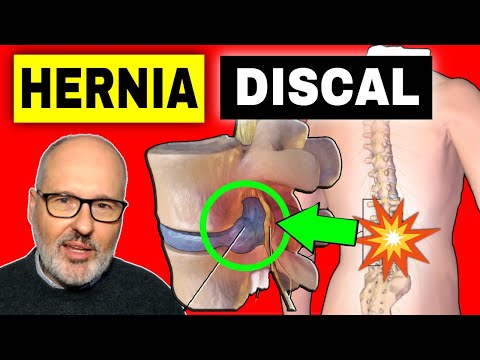 HERNIA DISCAL: SÍNTOMAS, CAUSAS y SOLUCIONES