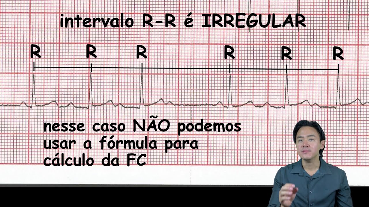 Eletrocardiograma - análise - BAV 2grau mobitz 1