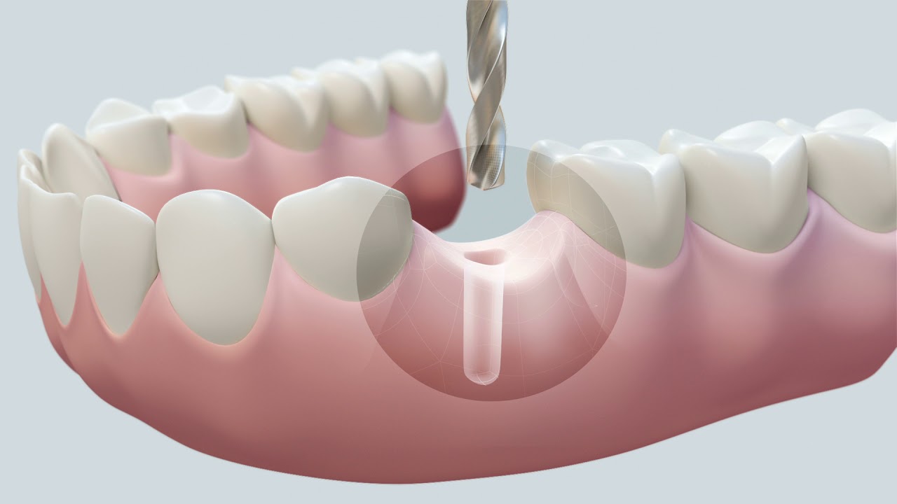 Same Day Dental Implants NYC - Video