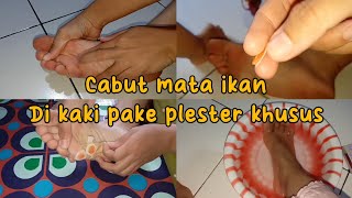 Download lagu CARA MENGHILANGKAN MATA IKAN DI KAKI mp3