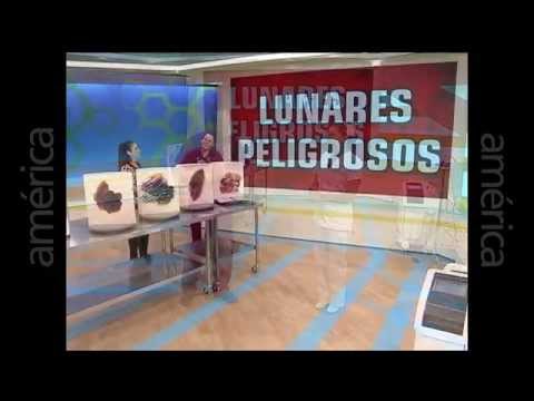 Lunares malignos: Prevenir el cancer por un lunar maligno o melanoma – entrevista en Dr. TV