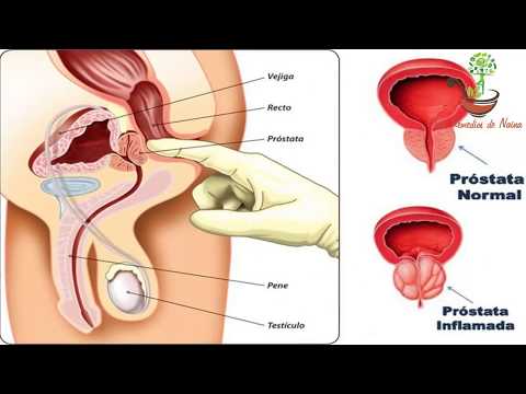 Entschlüsselungs TRUS Prostata- Fibrose Prostata Fotos