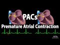 Premature Atrial Contractions (PACs), Animation.