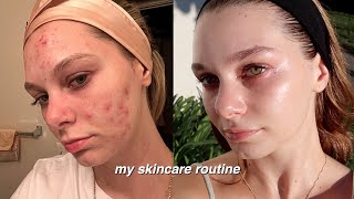 how skin cycling TRANSFORMED my acne prone skin