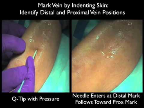 Peripheral Venous Access Under Ultrasound Guidance - Part 2 - Sonosite, Inc.