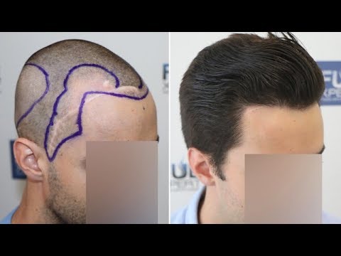 FUE Hair Transplant (2516 Grafts NW III A) By Dr Juan...