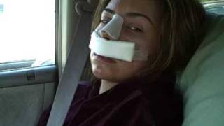 Nose Job Recovery Video