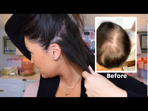 How I Grew My Hair Back Naturally! My Hair Loss Journey (Before and After)
