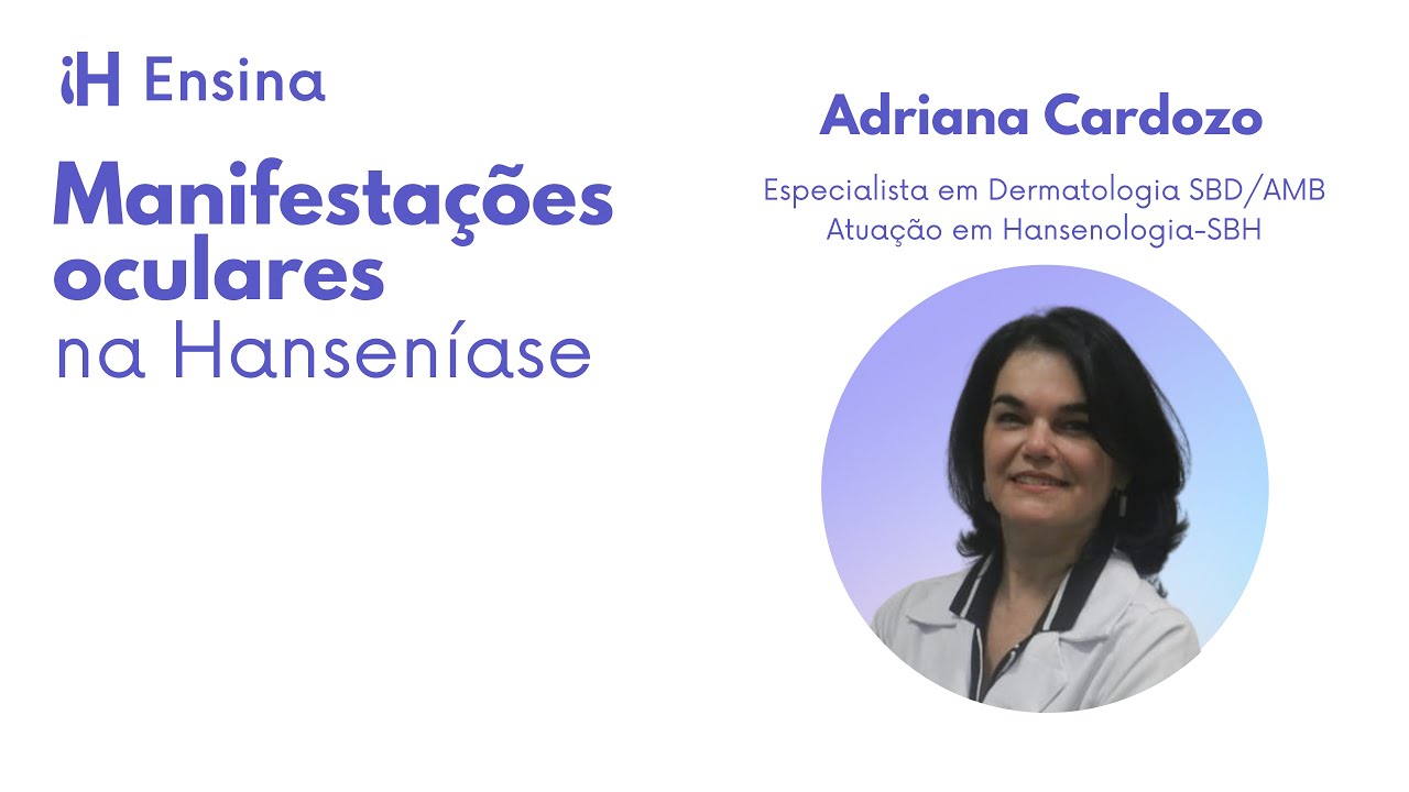 Manifestações oculares na Hanseníase - Dr.ª Adriana V  Cardozo