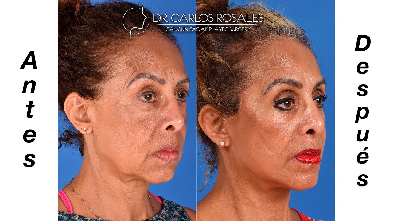 Lifting Facial Antes y después