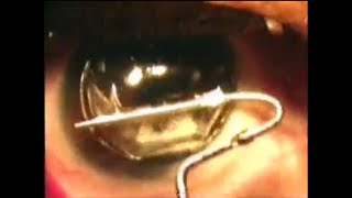 Femtoflap separation with laser ablation
