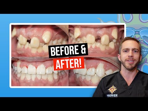 Braces BEFORE & AFTER: Severe Crowding!
