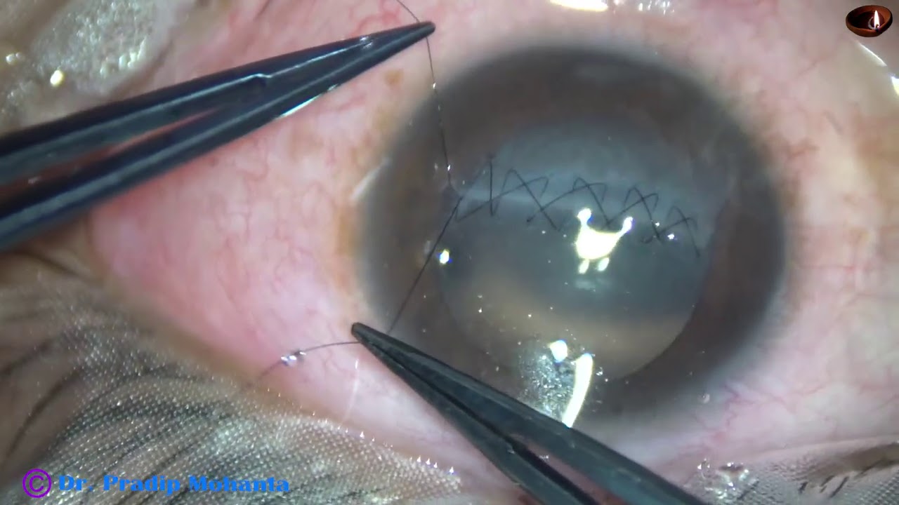 CORNEAL WOUND REPAIR by 10/0 nylon suture : Dr Pradip Mohanta, MS Ophth. 15th March, 2021