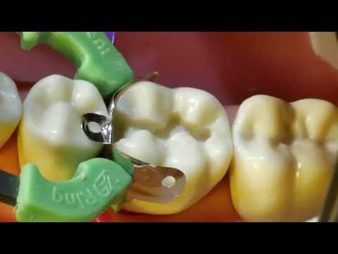 Class 2 Composites: 19 MO Approximal Box and Occlusal Fill Walkthrough