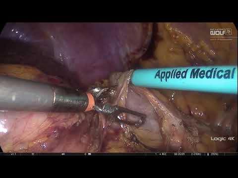 Laparoscopic left nephroureterectomy prior to radical cys...