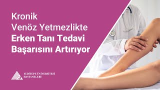 Kronik Venöz Yetmezlikte Erken Tanı Tedavi Başarısını Artırıyor | Doç.Dr. Baran 
