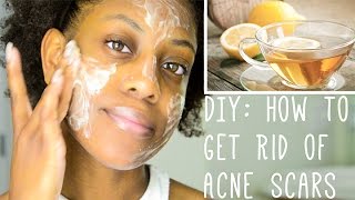 How to get rid of acne scars | DIY face mask