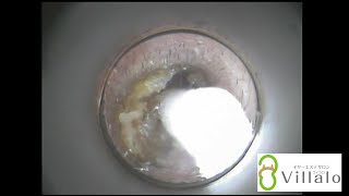 耳掃除動画vol.15「カチカチ耳垢さん　痛い耳掃除はもう卒業！」