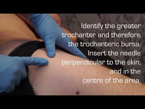 Injection Technique of the Trochanteric Bursa for Bursitis