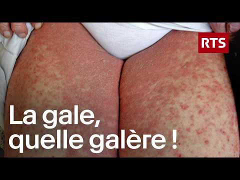 Scabies? It doesn't just happen to other people! | RTS