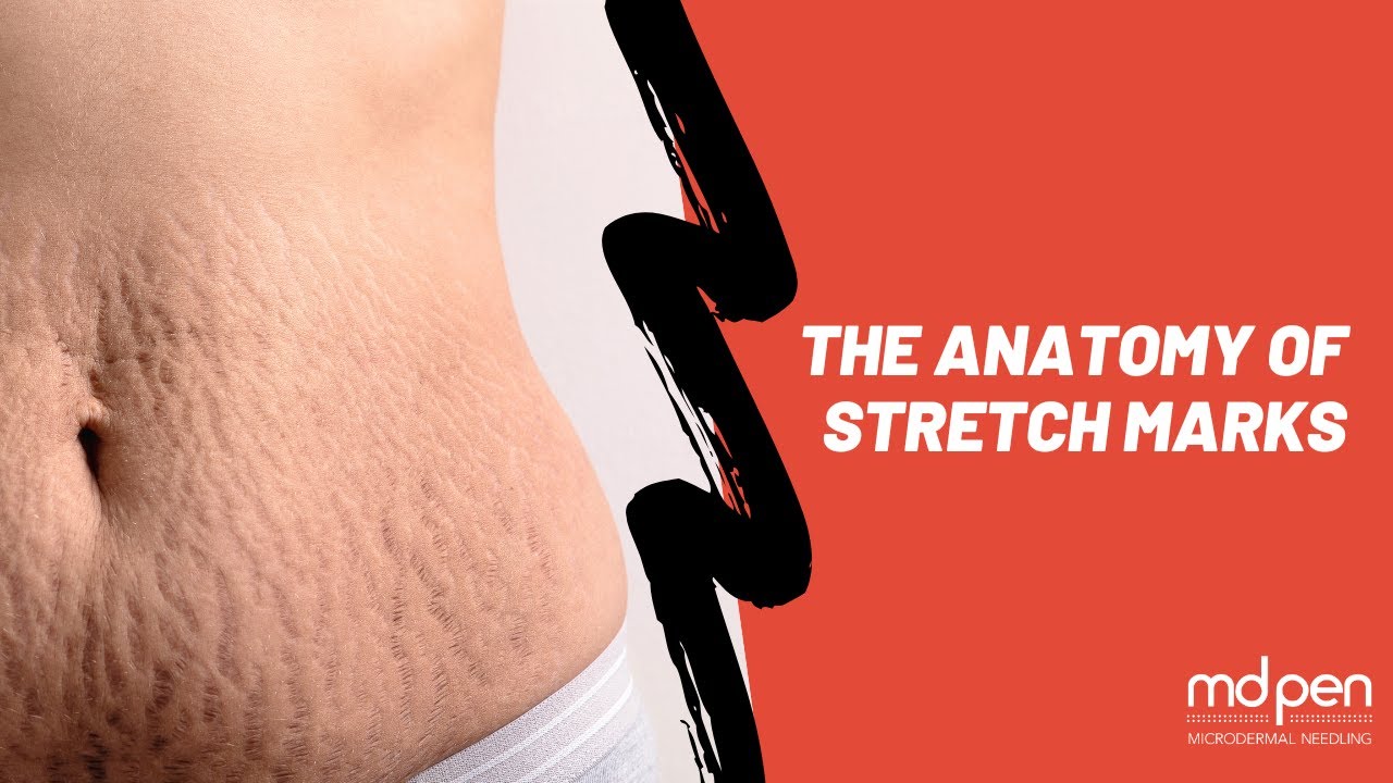 The Anatomy of Stretch Marks