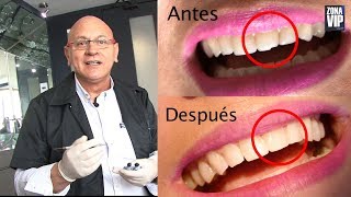 POR QUÉ SE ME ROMPEN LOS DIENTES 
