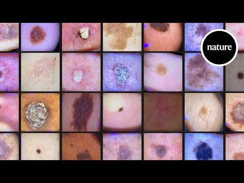 Can AI Help Identify Skin Cancer?