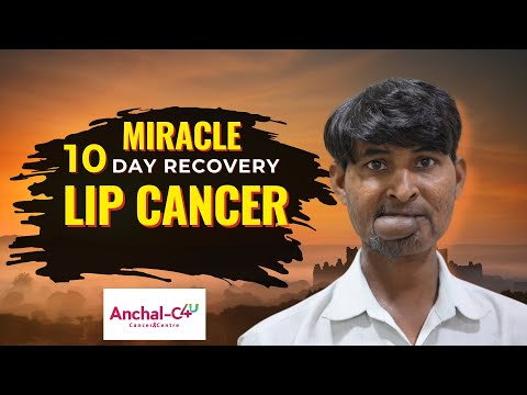 Cancer in Lower Lip: 10 Day Recovery