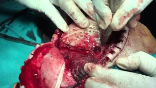 Extradural haematoma surgery